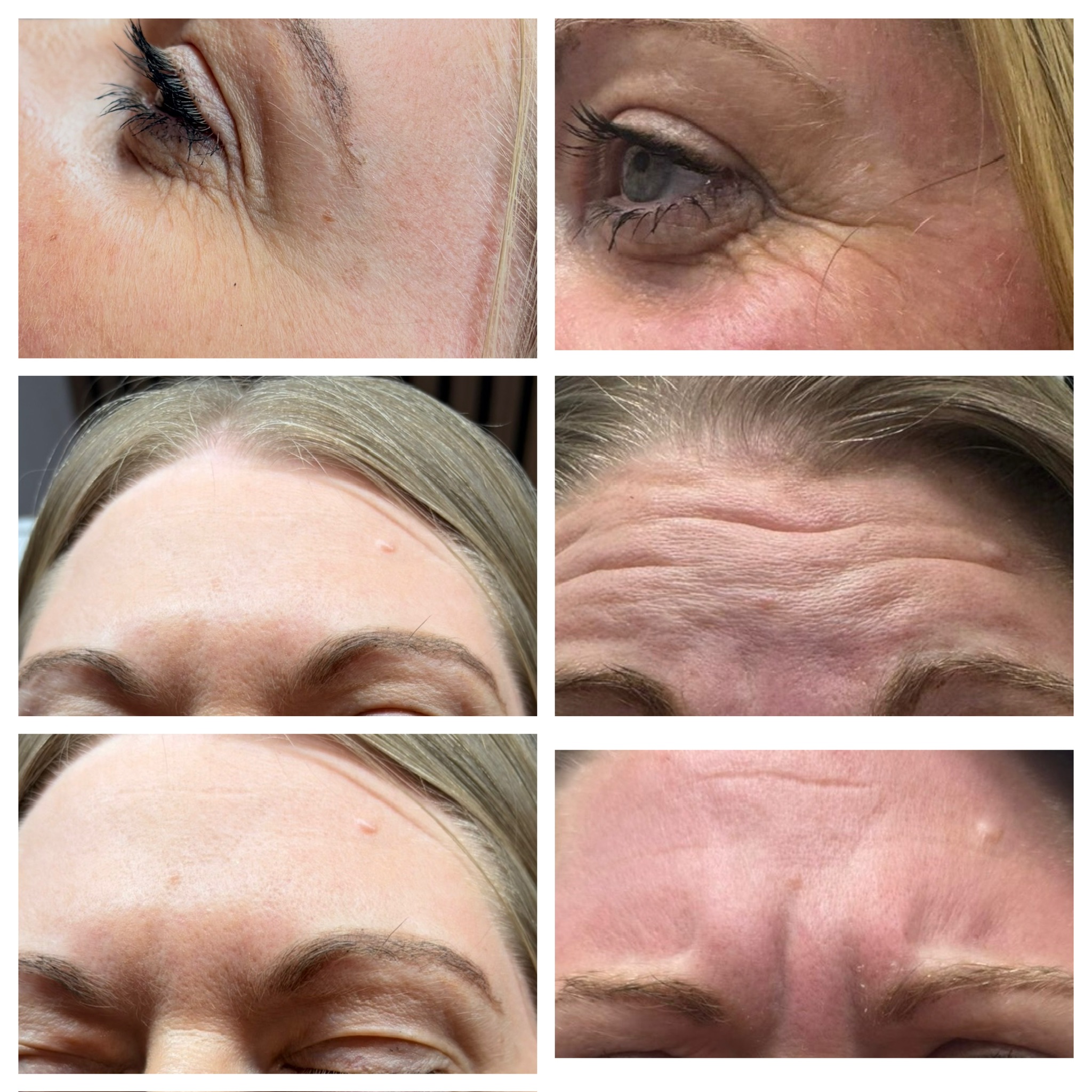 Anti-Wrinkle & Botox Injections at Lumina Co-Lab: Smooth Fine Lines & Achieve Natural, Youthful Skin