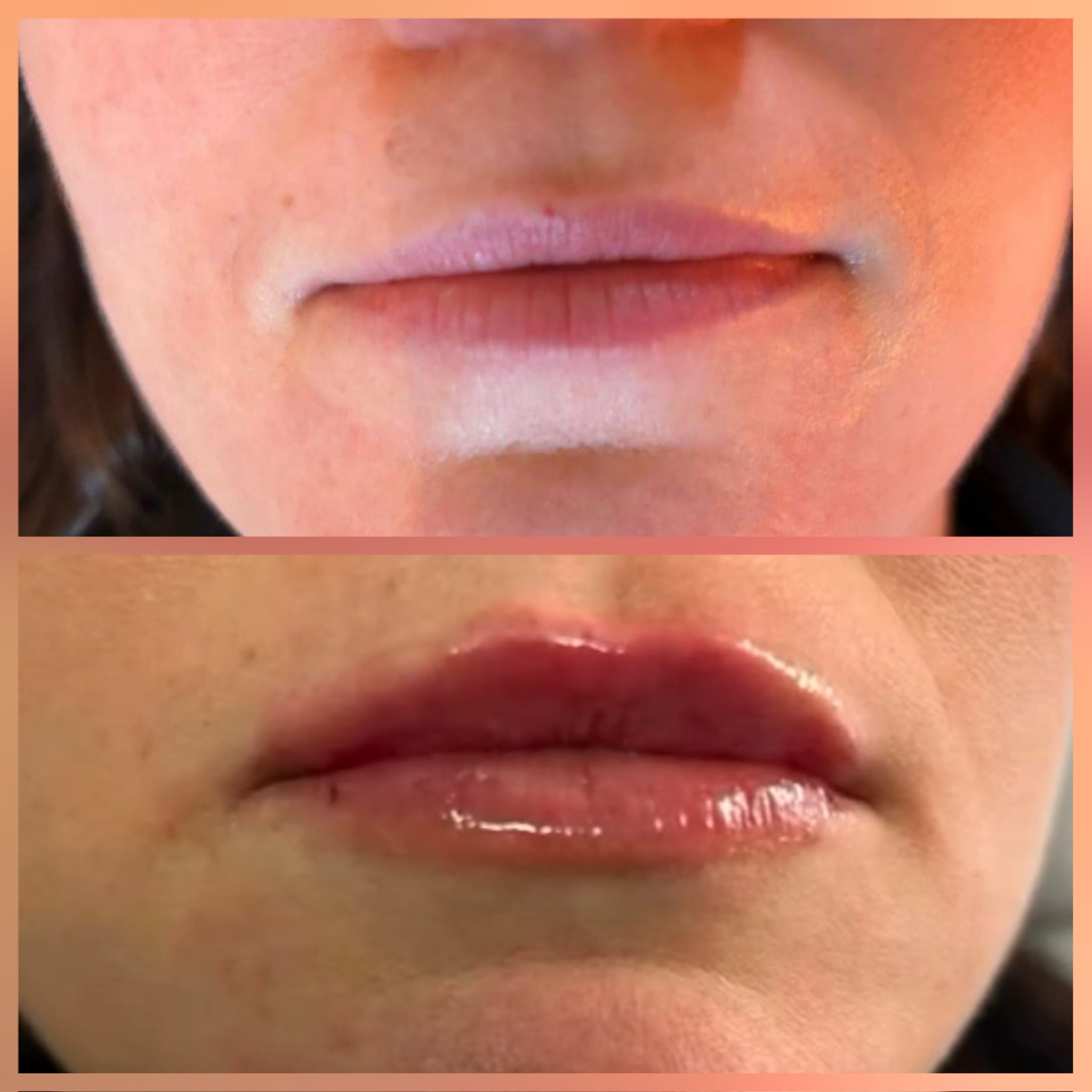 Dermal Fillers: Restore Volume, Enhance Features & Achieve Natural-Looking Results