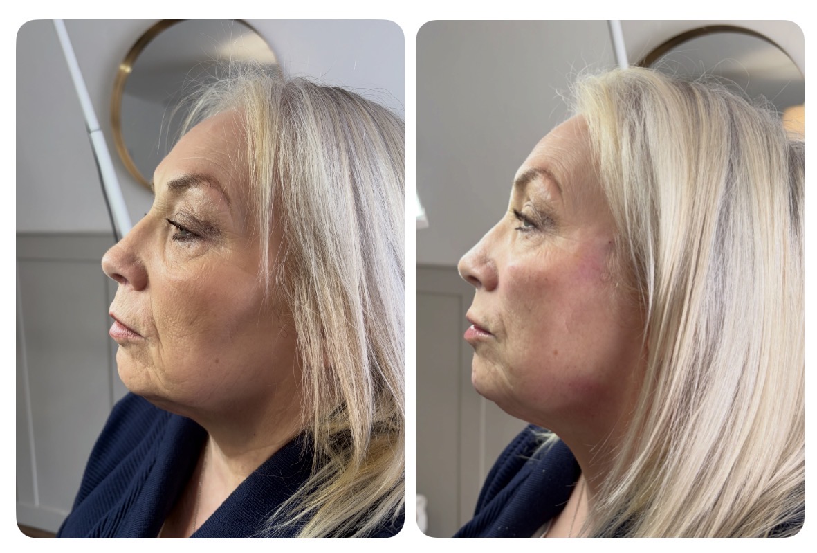 Dermal Fillers: Myths vs Facts – Everything You Need to Know Before Treatment