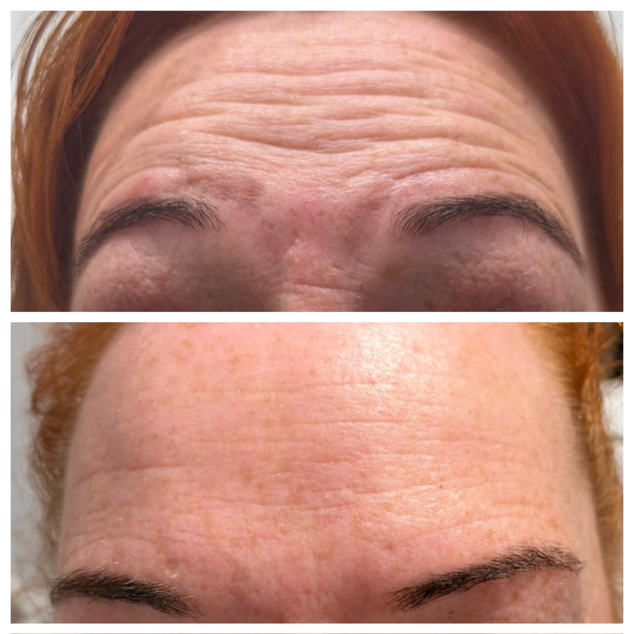 Botox Myths vs Facts: The Truth About Anti-Wrinkle Injections