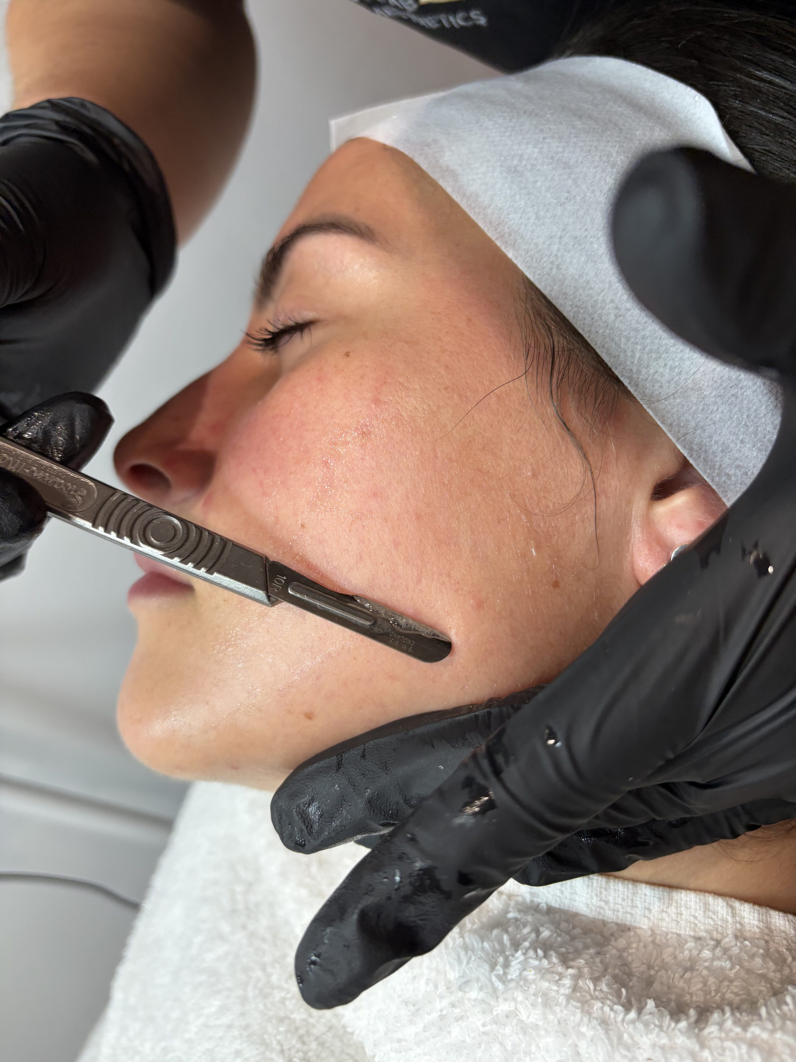 Aesthetic Treatments for Acne-Prone Skin & Acne Scarring: Clearer, Smoother Skin Starts Here