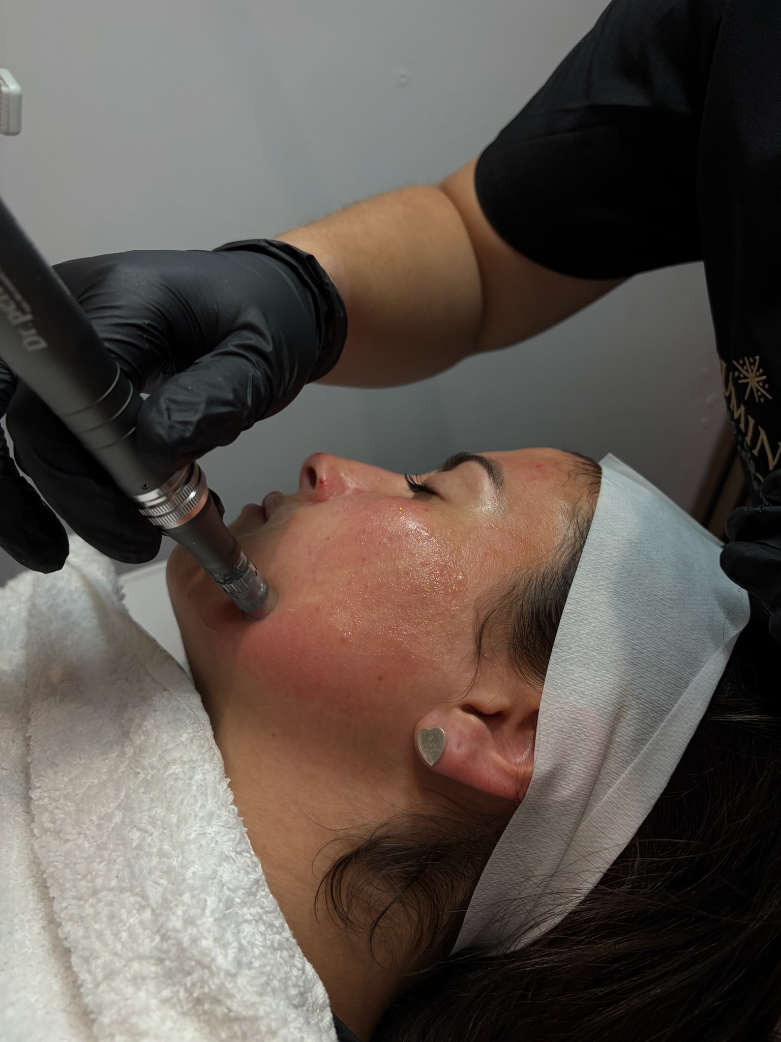 Which Microneedling Treatment Should You Choose? | Lumina Co-Lab Guide