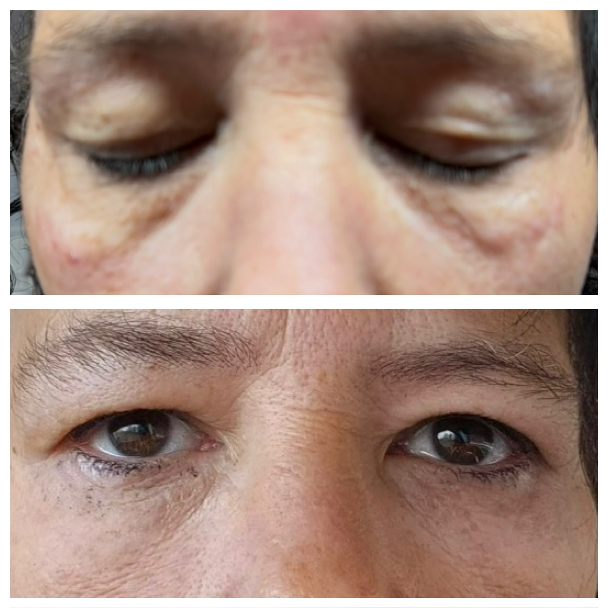 Derma 2.0 Eyes vs Polynucleotides: Which Under-Eye Treatment Is Right for You?